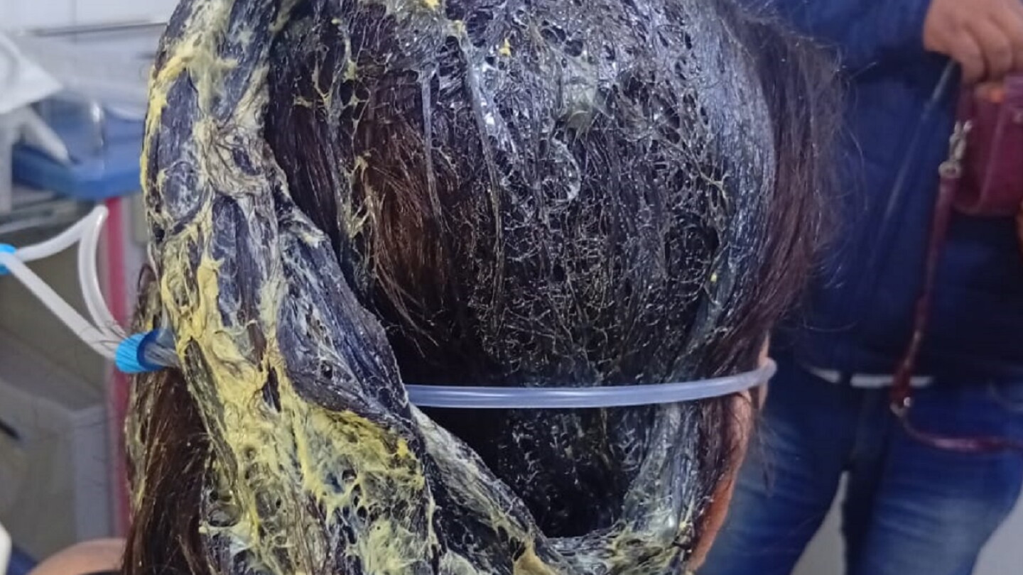 Brasileño derrama cola de zapatero al cabello de su pareja en Pedro Juan Caballero
