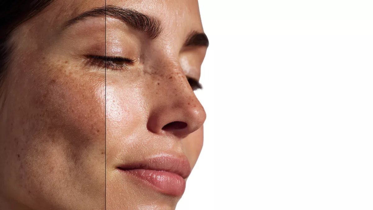 Hiperpigmentación en verano: cómo prevenir manchas y proteger la piel del sol